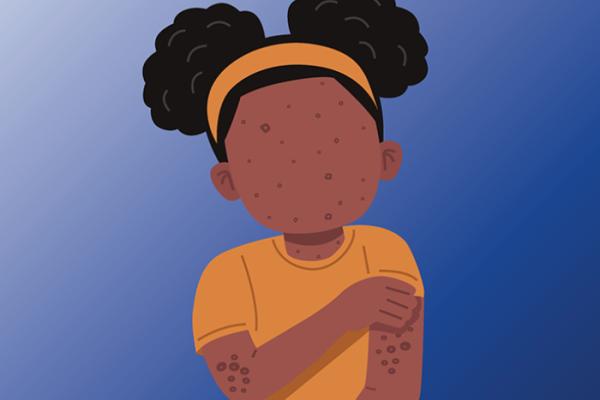 Protect your child against measles