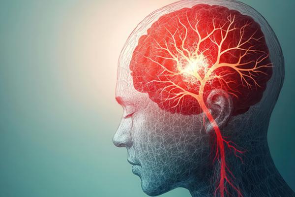 Transforming stroke care for patients and health professionals